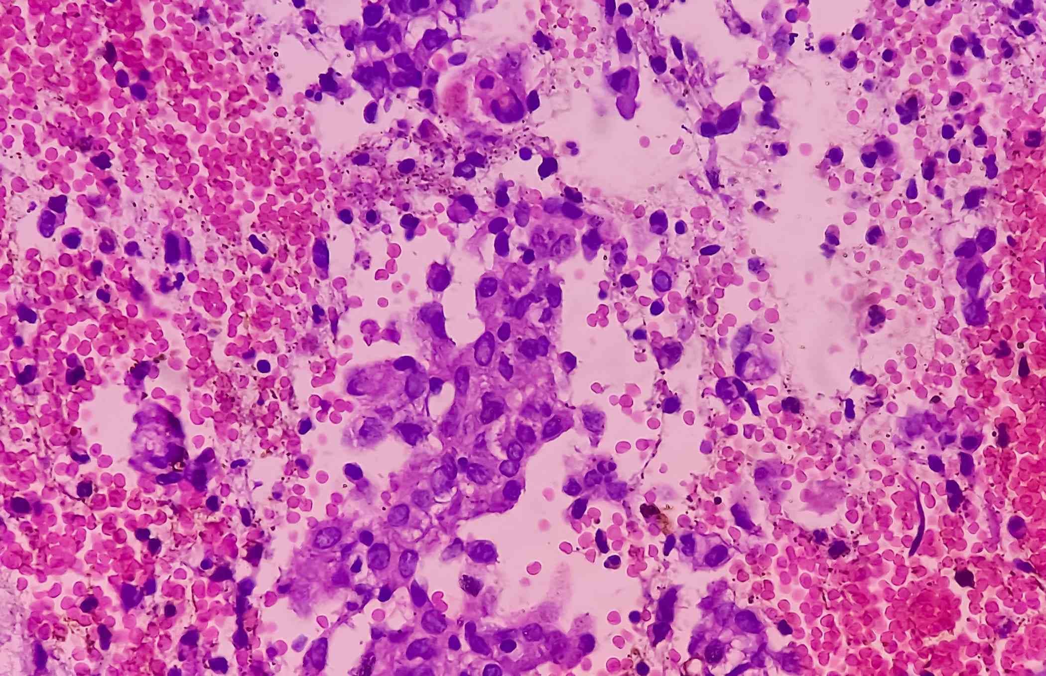 Un nuevo fármaco se muestra eficaz frente al cáncer de endometrio